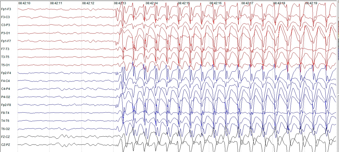 Alt text: Imagem de um encefalograma representado por 18 gráficos lineares oscilando entre várias frequências organizadas em 18 gráficos organizados verticalmente que variam entre os tons de vermelho, tons de laranja, roxo, azul e verde de cima para baixo. Não é possivel definir os valores do eixo y e o eixo x tem valores de alguns segundos variando de 08:42:10 segundos até 08:12:19 segundos.